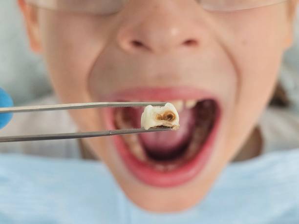 Best Emergency Treatment for Toothache in Le Mars, IA